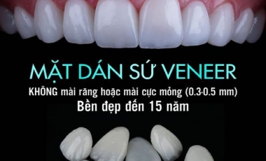 Răng sứ Veneer