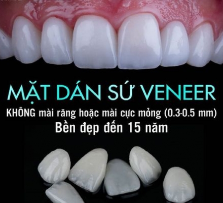 Răng sứ Veneer